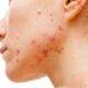 Tot ceea ce trebuie să știți despre acnee, de la cele mai bune produse de piele până la impactul psihologic