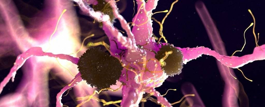 Studiul făcut pe mai multe imagini cu materia cerebrală sugerează că Parkinson ar putea fi de fapt două boli într-una