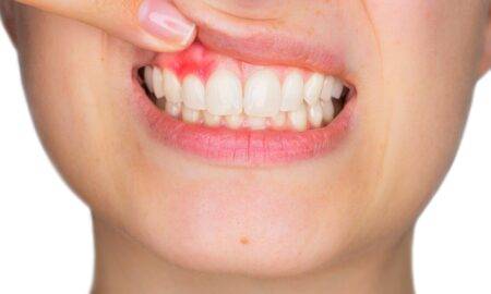Cum recunoaștem o infecție dentară și cum o putem trata cât mai rapid?