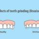 Bruxismul, scrâșnirea inconștientă a dinților - cauze, simptome și tratament