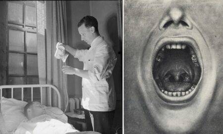 Smulsul dinților, o formă de terapie psihiatrică? Henry Cotton a ucis sute de pacienți crezând această teorie