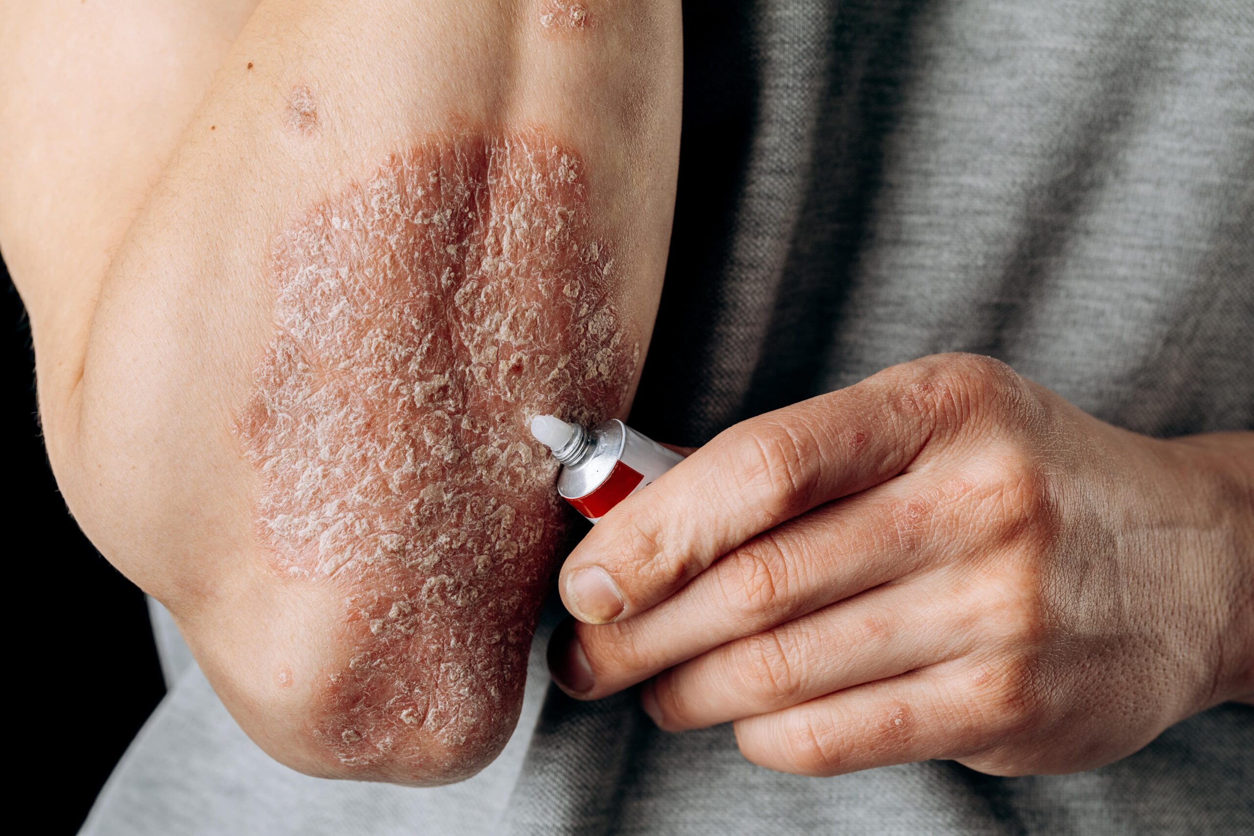 Află tot ce trebuie să știi despre cele mai frecvente boli ale pielii